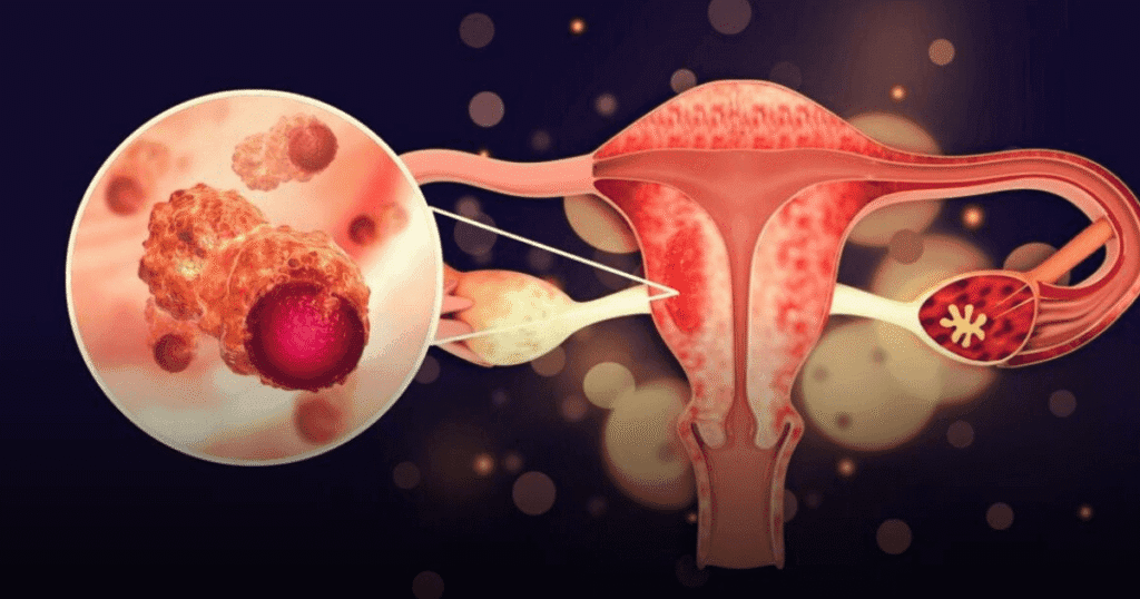 cáncer de ovario