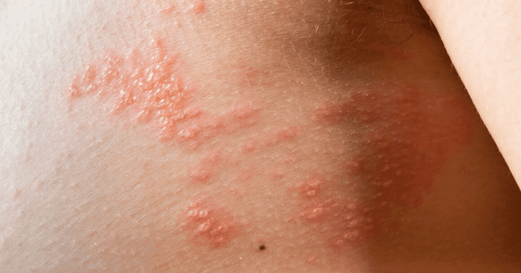 remedios para infecciones