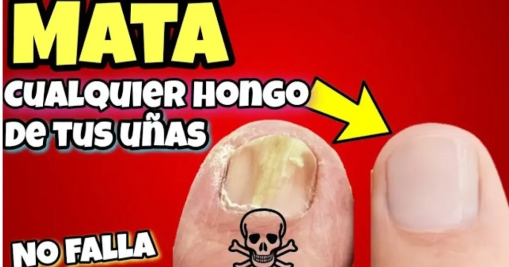 vinagre para hongos